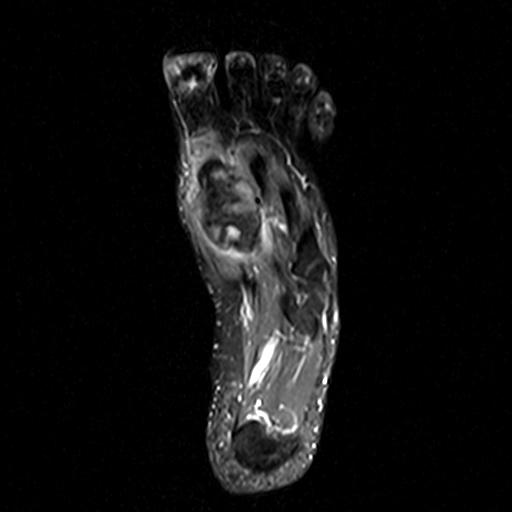 Foot ABC MRI